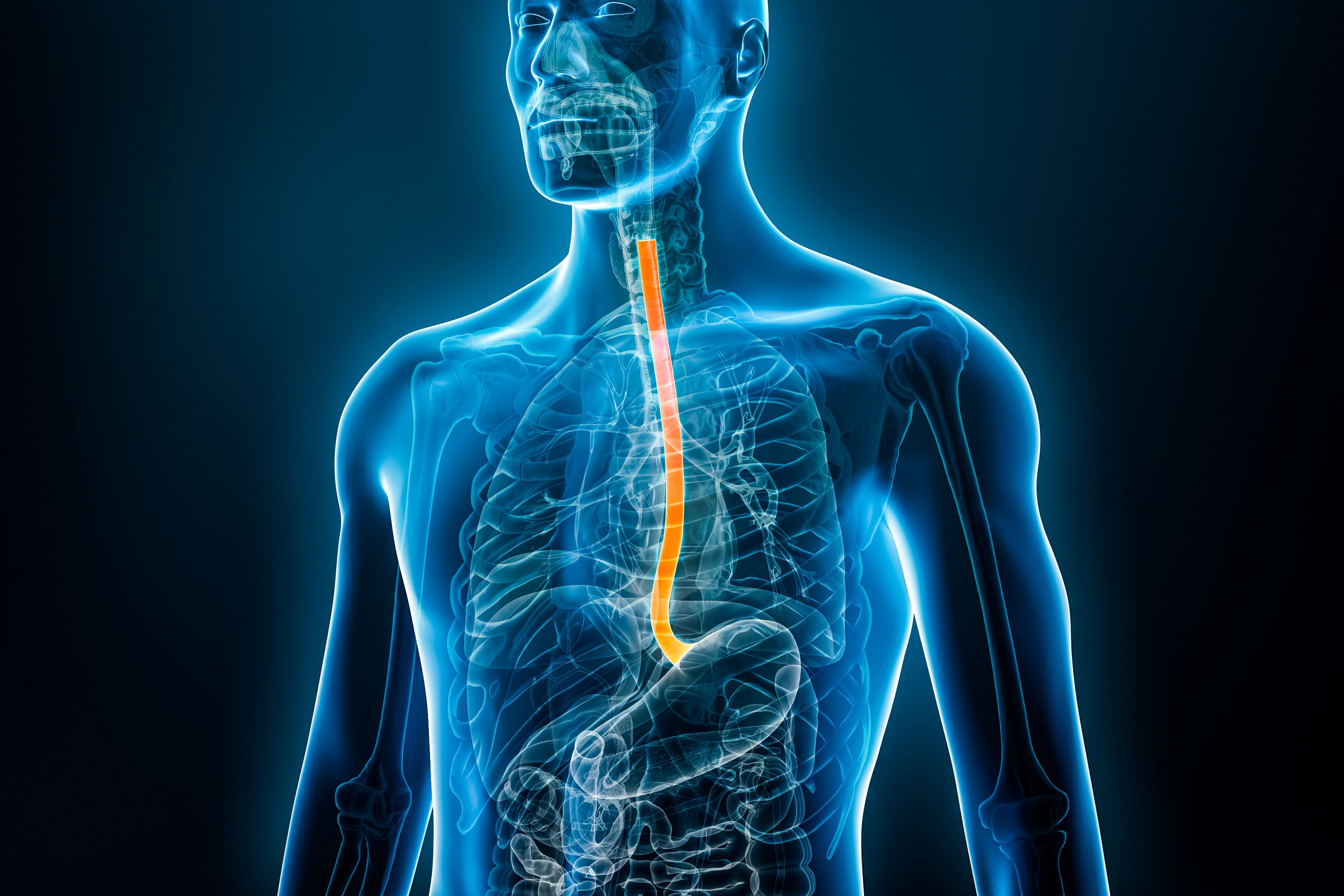 As esophageal cancer incidence rises, trials and potential treatments burgeon: Novotech report