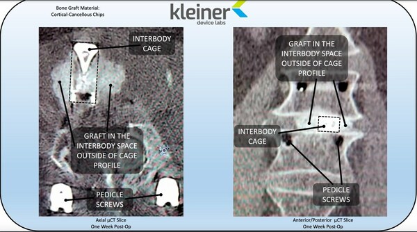 Kleiner Device Labs Completes First 50 Surgical Cases With KG2 Surge Flow-Thru Interbody System