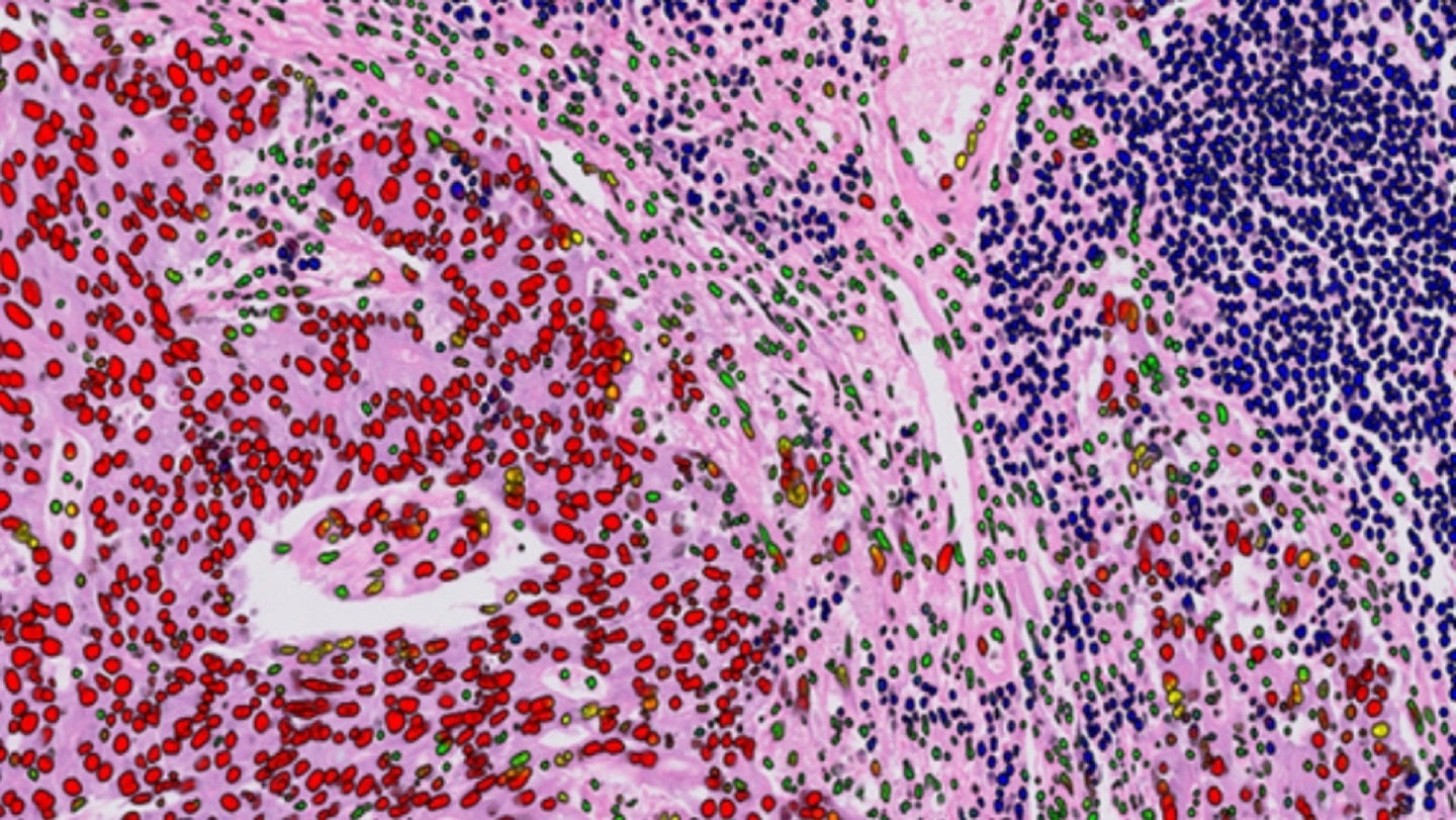 ICR and Royal Marsden NHS Foundation Trust open new integrated pathology unit