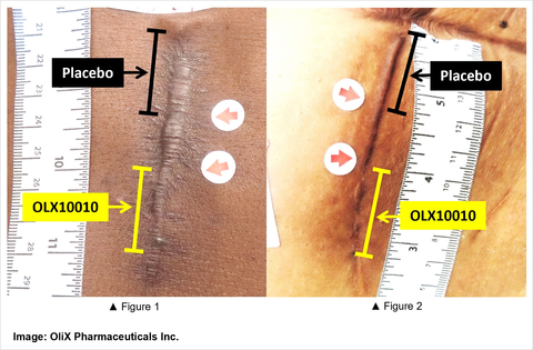 OliX Pharmaceuticals Announces Positive Results from a Phase 2a Trial of OLX10010 for Hypertrophic Scar Treatment