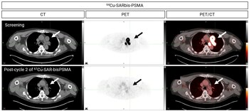 First patient with metastatic prostate cancer to receive 2 doses of Cu-67 SAR-bisPSMA achieves undetectable PSA level