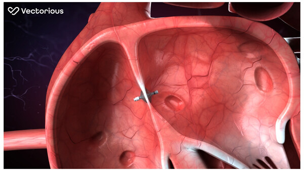 Vectorious Medical Technologies Announces First U.S. Patient Implanted with the V-LAP Left Atrial Pressure Sensor