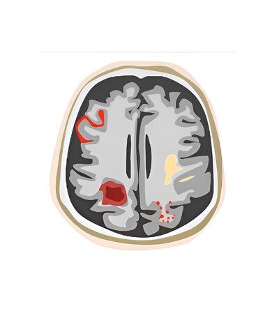 FDA authorizes the first AI-driven MRI solution for safer Alzheimer's treatment