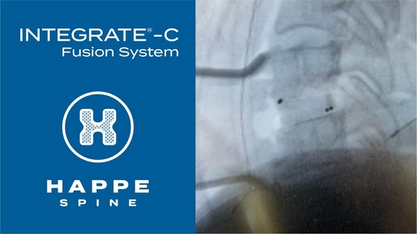 HAPPE Spine Announces First Clinical Use of the INTEGRATE®-C Interbody Fusion System