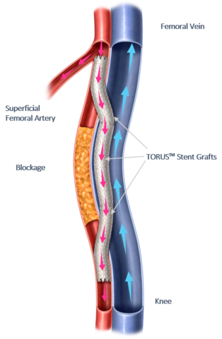 Endologix Announces 24-Month Results of DETOUR-2 Study at 2023 Vascular Annual Meeting