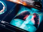 Momentous BioNTech Lung Cancer Vaccine Trial Underway