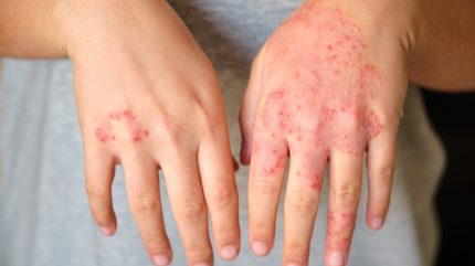 EC authorises LEO Pharma Anzupgo cream for chronic hand eczema