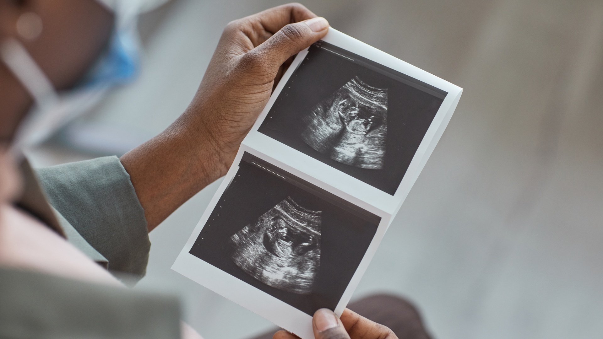 GE HealthCare drops $51M to buy OB/GYN-focused ultrasound AI