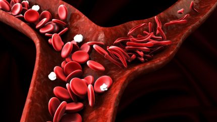 NHS to provide Pfizer’s Voxelotor to treat sickle cell disease