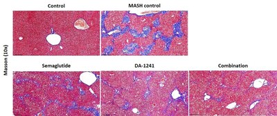 NeuroBo Pharmaceuticals' DA-1241 in Combination with Semaglutide Improves Liver Fibrosis and Demonstrates Additive Hepatoprotective Effects in Pre-Clinical MASH Models Compared to Either Treatment, Alone