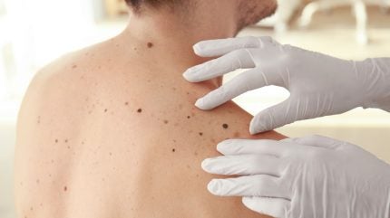 China NMPA approves KeChow’s tunlametinib for melanoma
