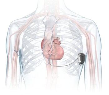 Medtronic receives FDA approval for extravascular defibrillator to treat abnormal heart rhythms, sudden cardiac arrest