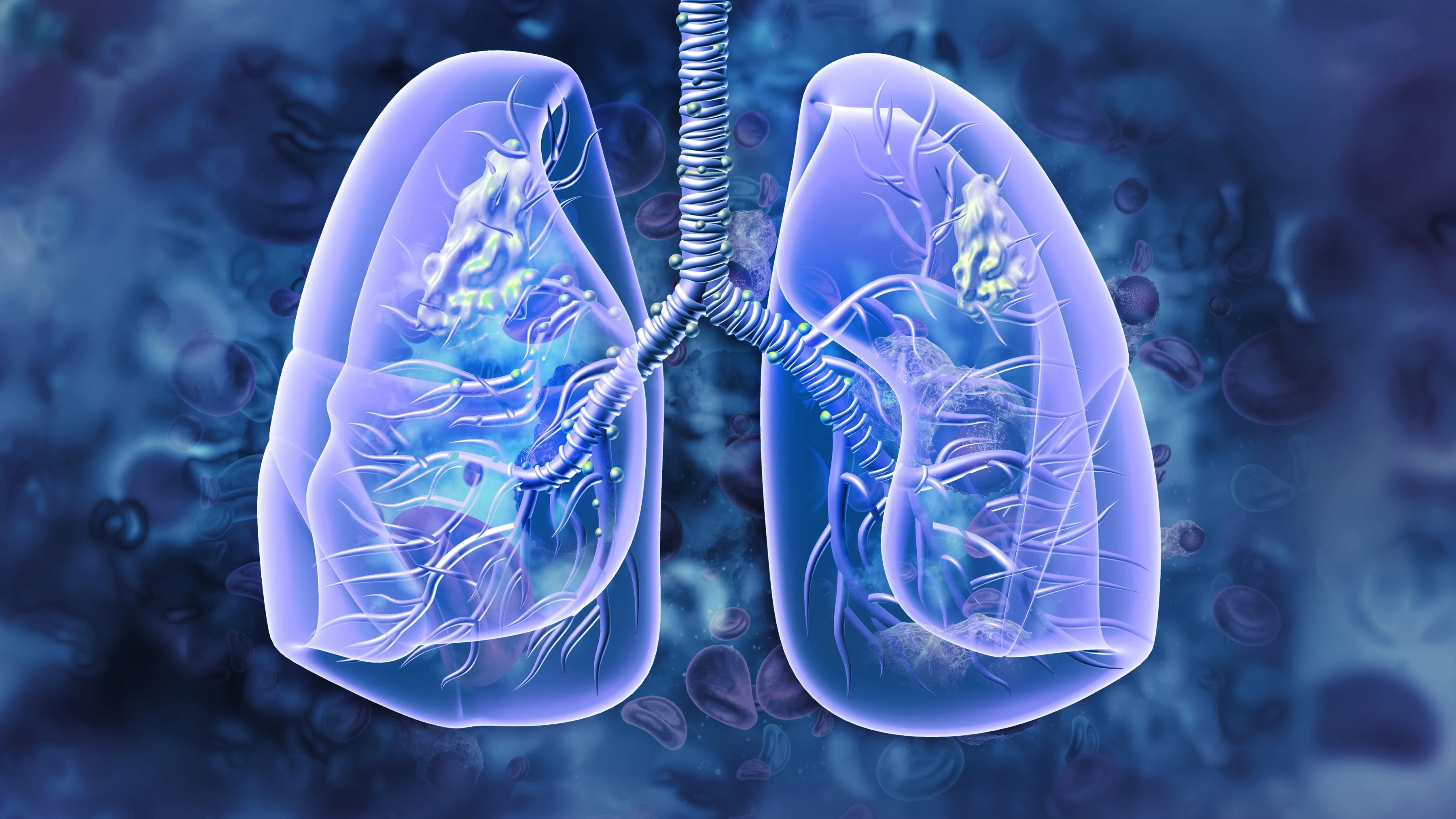 Intuitive joins $14M funding for lung cancer AI developer Optellum